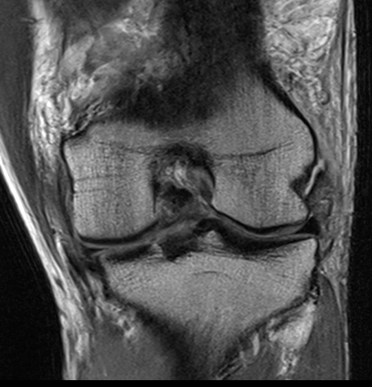 LCL avulsion femur